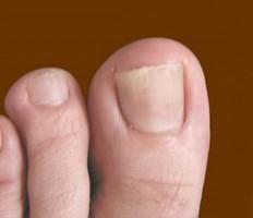 האם משחה יעילה מן הפטרייה של הציפורניים על הרגליים?