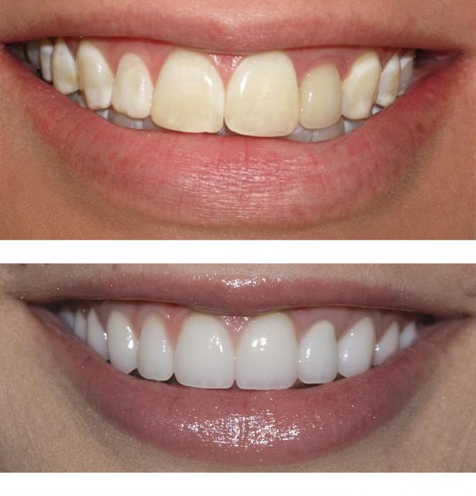 ניקוי שיניים בלייזר מאבן: התוויות נגד לפרוצדורה