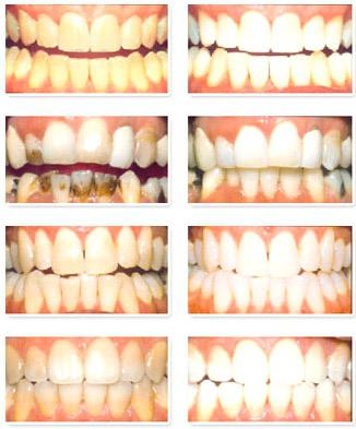 כמה הוא הלבנת שיניים ברפואת שיניים. תכונות של הלבנת שיניים ברפואת שיניים מודרנית